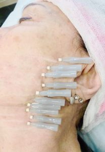 Thread Lifting of Face, Neck, Decolete | Healthy Looks in Rufford, Newark, UK